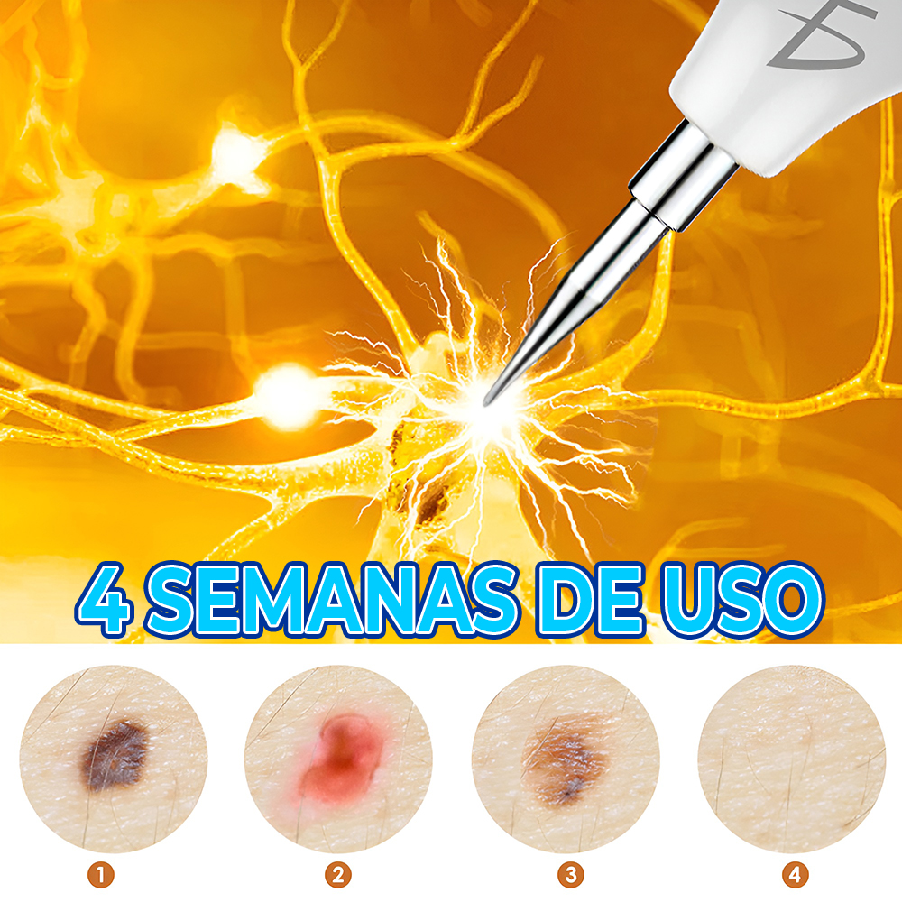 Pluma de eliminación de lunares manchas pecas y removedor de verrugas - Image 2
